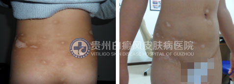 使用了这一技术,九岁女孩90天告别白癜风