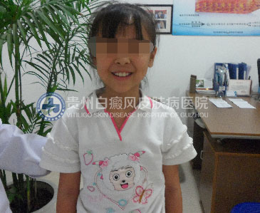 使用了这一技术,九岁女孩90天告别白癜风