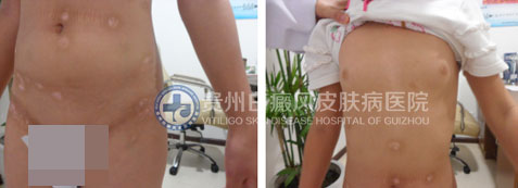 使用了这一技术,九岁女孩90天告别白癜风