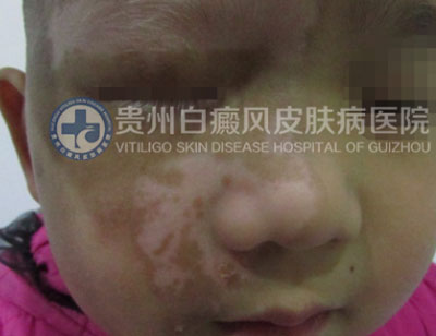 徐某 面部 散在型-进展期白癜风 3年