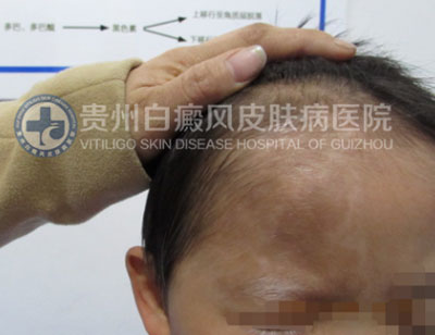 徐某 面部 散在型-进展期白癜风 3年