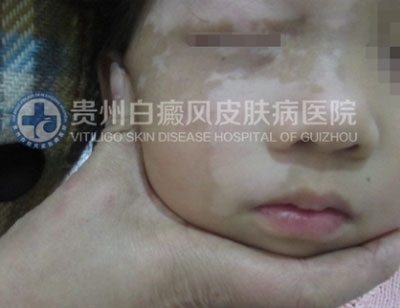 徐某 面部 散在型-进展期白癜风 3年