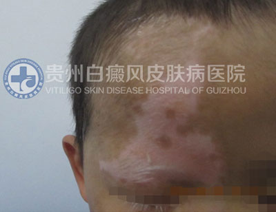 徐某 面部 散在型-进展期白癜风 3年