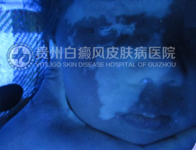 徐某 面部 散在型-进展期白癜风 3年