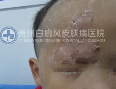 徐某 面部 散在型-进展期白癜风 3年