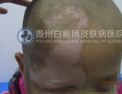 徐某 面部 散在型-进展期白癜风 3年