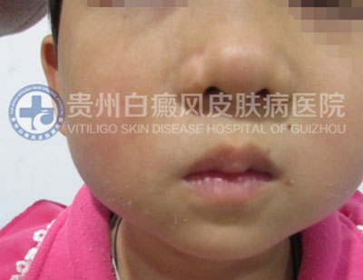 徐某 面部 散在型-进展期白癜风 3年