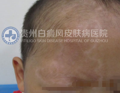 徐某 面部 散在型-进展期白癜风 3年