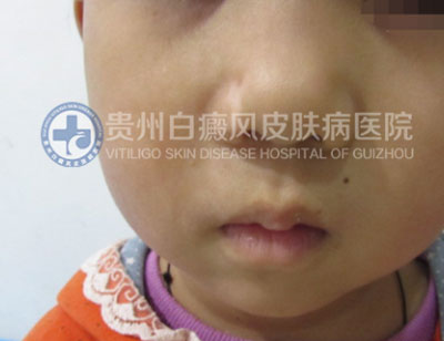 徐某 面部 散在型-进展期白癜风 3年