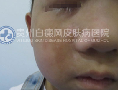 徐某 面部 散在型-进展期白癜风 3年