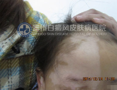 徐某 面部 散在型-进展期白癜风 3年