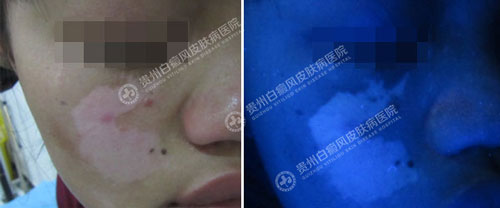 案例分享:白斑不除,何以成女神?
