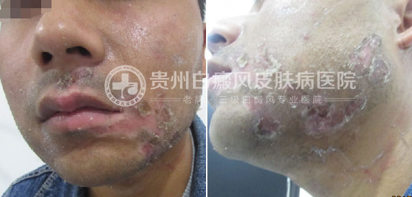 29岁小伙,祛除白癜风美梦成真