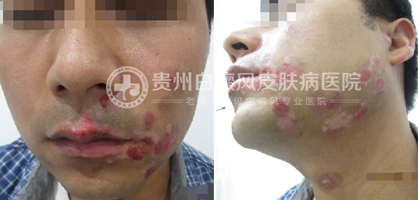 29岁小伙,祛除白癜风美梦成真