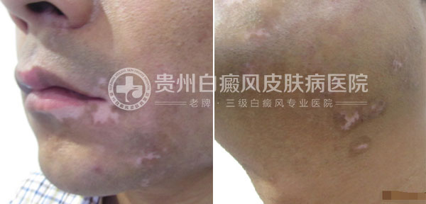 29岁小伙,祛除白癜风美梦成真