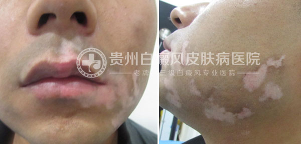 29岁小伙,祛除白癜风美梦成真