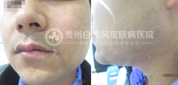 29岁小伙,祛除白癜风美梦成真