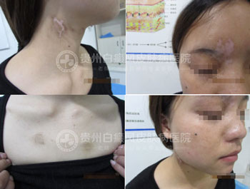 身上多处白斑终治愈,患者锦旗相送表谢意