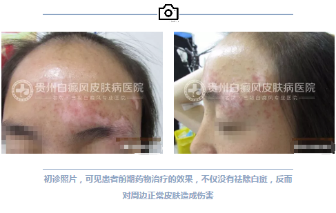 妙龄女白斑康复 赠锦旗落泪感恩